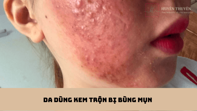  Da Dùng kem trộn bị bùng mụn