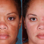 ket-hop-tretinoin-va-hydroquinone-giup-ban-dieu-tri-sac-to-da-hieu-qua