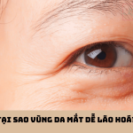 tai-sao-vung-da-mat-de-lao-hoa-min