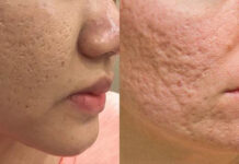 Retinol ZO Skin Wrinkle Có Giúp Điều Trị Mụn? Tại sao nên chọn retinol Zo Skin Wrinkle để điều trị mụn