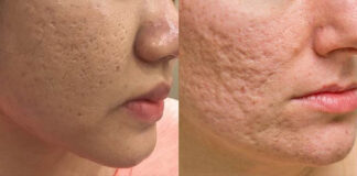 Tại sao nên chọn retinol Zo Skin Wrinkle để điều trị mụn