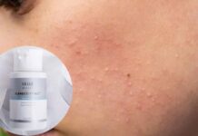 DÙNG BHA BỊ BÙNG PHÁT MỤN VIÊM NHIỀU VÀ XUẤT HIỆN MỤN ĐẦU TRẮNG