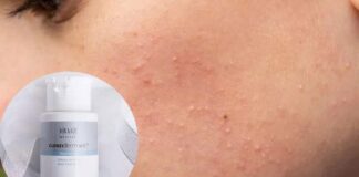 DÙNG BHA BỊ BÙNG PHÁT MỤN VIÊM NHIỀU VÀ XUẤT HIỆN MỤN ĐẦU TRẮNG