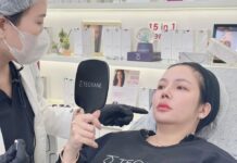 Tiêm filler an toàn và hiệu quả để tránh over filler