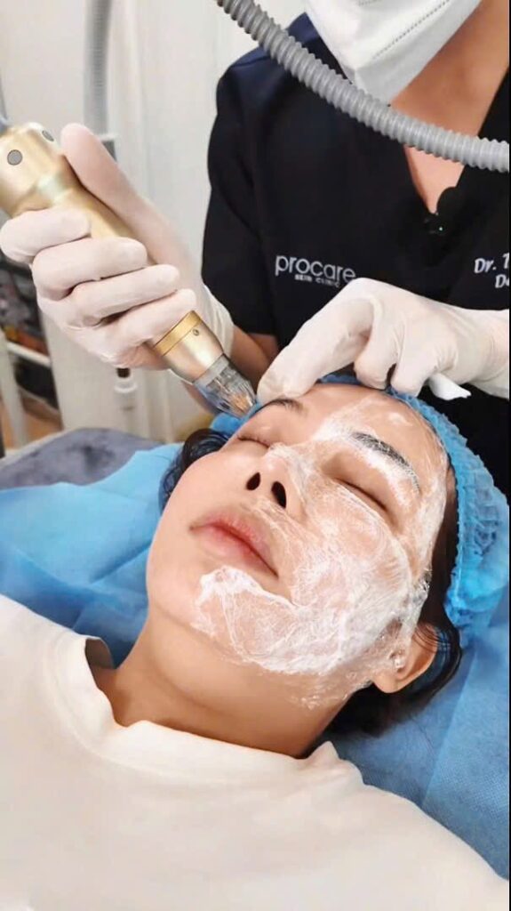 Nâng cơ trẻ hóa bằng phương pháp không xâm lấn HIFU, Ultherapy, Softwave, Thermage, RF Needles