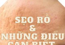 Sẹo rỗ và những điều cần biết để phục hồi da Những điều cần biết khi điều trị sẹo rỗ