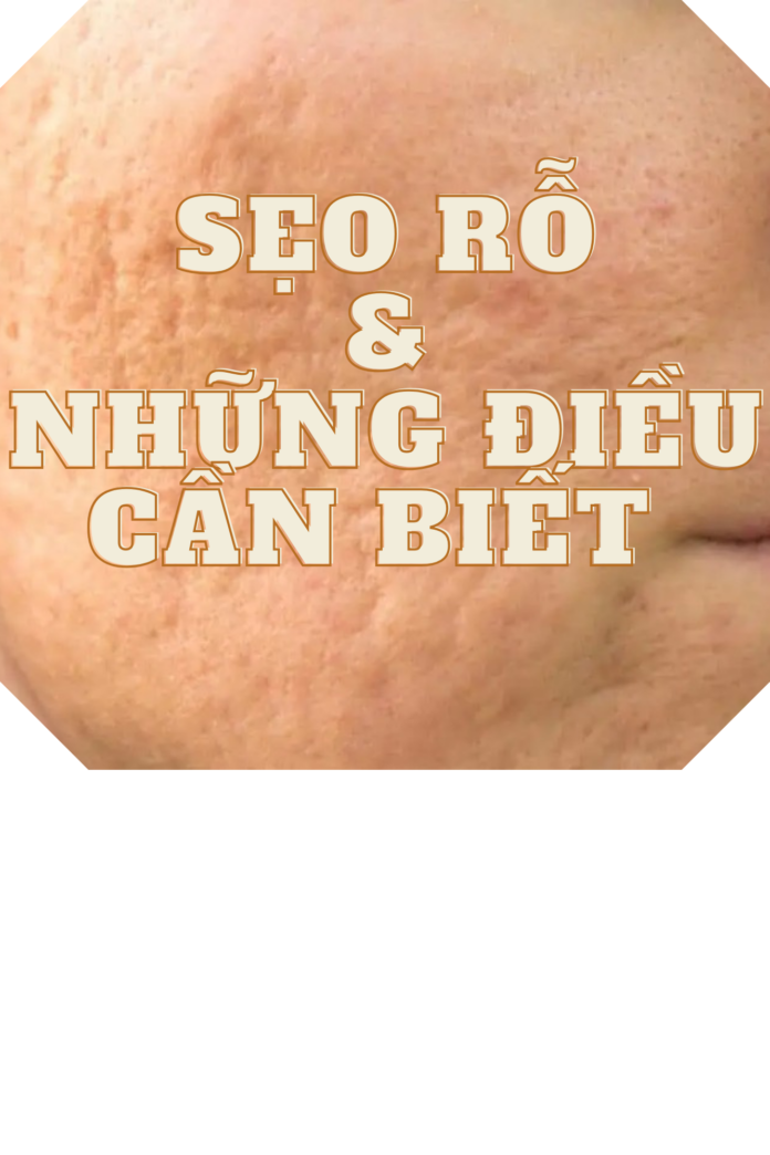 Những điều cần biết khi điều trị sẹo rỗ