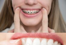 Hàm duy trì có quan trọng sau khi niềng răng? Niềng Răng – Vì Sao Hàm Duy Trì Quan Trọng Để Giữ Kết Quả Lâu Dài?