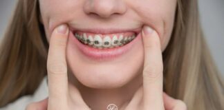 Hàm duy trì có quan trọng sau khi niềng răng? Niềng Răng – Vì Sao Hàm Duy Trì Quan Trọng Để Giữ Kết Quả Lâu Dài?