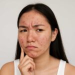 5 Nguyên Tắc Vàng Để Tránh Bị Bùng Mụn Sau Khi Hết Mụn