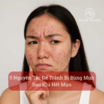 5 Nguyên Tắc Vàng Để Tránh Bị Bùng Mụn Sau Khi Hết Mụn (2)