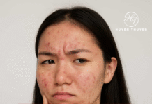 5 Nguyên Tắc Vàng Tránh Bị Bùng Mụn Sau Khi Hết Mụn 5 Nguyên Tắc Vàng Để Tránh Bị Bùng Mụn Sau Khi Hết Mụn