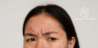 5 Nguyên Tắc Vàng Để Tránh Bị Bùng Mụn Sau Khi Hết Mụn