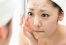Bí Quyết Skincare Cho Làn Da Mụn Và Trắng Sáng