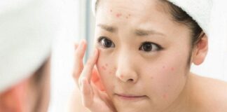 Bí Quyết Skincare Cho Làn Da Mụn Và Trắng Sáng