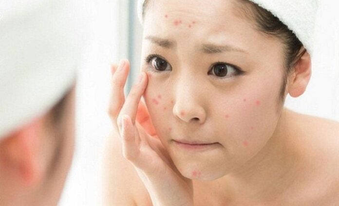 Bí Quyết Skincare Cho Làn Da Mụn Và Trắng Sáng