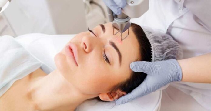 Chăm da sau laser Fractional CO2: Hướng dẫn toàn diện