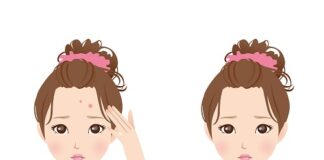 Kiểm soát dầu thừa: Giải pháp cho làn da mụn và sợi bã nhờn