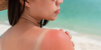 Bí quyết giải cứu cho làn da cháy nắng đen sạm