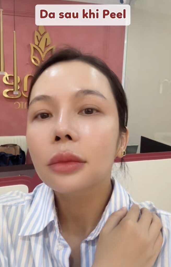 Peel da trắng sáng chỉ hai củ rưỡi tại Măng Skin Clinic có gì?