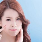 Chăm sóc da sau lấy nhân mụn thế nào cho đúng