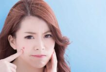 Chăm sóc da sau lấy nhân mụn thế nào cho đúng Chăm sóc da sau lấy nhân mụn thế nào cho đúng