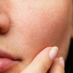 Tất tần tật lý do vì sao làm đủ mọi cách mà lỗ chân lông vẫn to?
