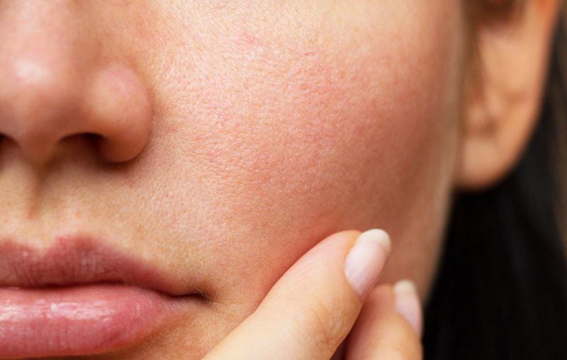 Tất tần tật lý do vì sao làm đủ mọi cách mà lỗ chân lông vẫn to?