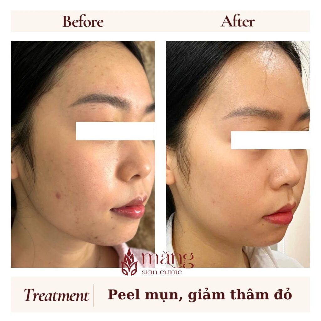 Peel da có nhất thiết phải "bong" mới đẹp?