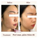 Peel da có nhất thiết phải “bong” mới đẹp?