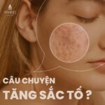 Top 6 cách trị nám da hiệu quả nhất hiện nay