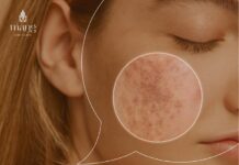 Top 6 cách trị nám da hiệu quả nhất hiện nay Top 6 cách trị nám da hiệu quả nhất hiện nay Địa chỉ phòng khám da liễu uy tín: Công ty TNHH Măng Skin Địa chỉ: 97C Phùng Văn Cung, P7, Q. Phú Nhuận, TP. Hồ Chí Minh Điện thoại: +84909385407 E-mail: mangskinclinic@gmail.com