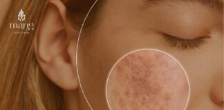 Top 6 cách trị nám da hiệu quả nhất hiện nay Địa chỉ phòng khám da liễu uy tín: Công ty TNHH Măng Skin Địa chỉ: 97C Phùng Văn Cung, P7, Q. Phú Nhuận, TP. Hồ Chí Minh Điện thoại: +84909385407 E-mail: mangskinclinic@gmail.com