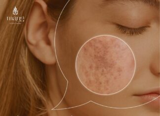 Top 6 cách trị nám da hiệu quả nhất hiện nay Địa chỉ phòng khám da liễu uy tín: Công ty TNHH Măng Skin Địa chỉ: 97C Phùng Văn Cung, P7, Q. Phú Nhuận, TP. Hồ Chí Minh Điện thoại: +84909385407 E-mail: mangskinclinic@gmail.com