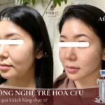 HIFU hay CFU: Đâu là lựa chọn “vàng” cho làn da trẻ hóa?