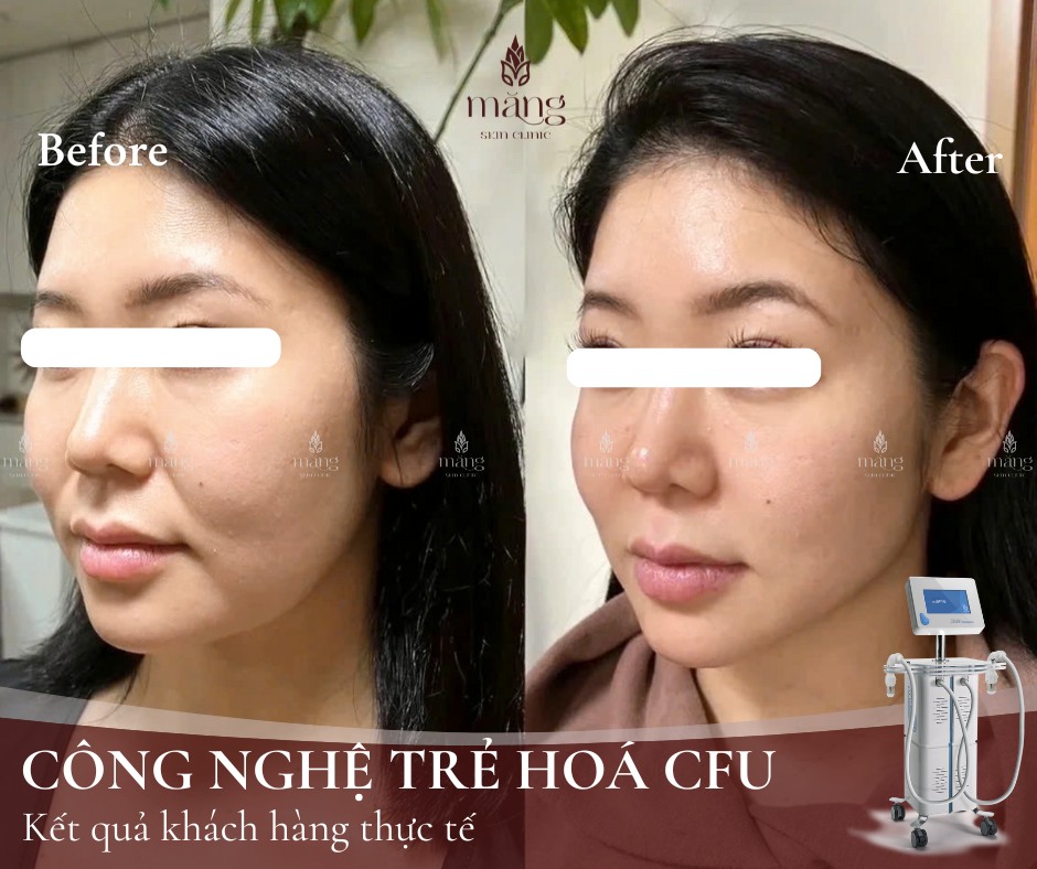 HIFU hay CFU: Đâu là lựa chọn "vàng" cho làn da trẻ hóa?