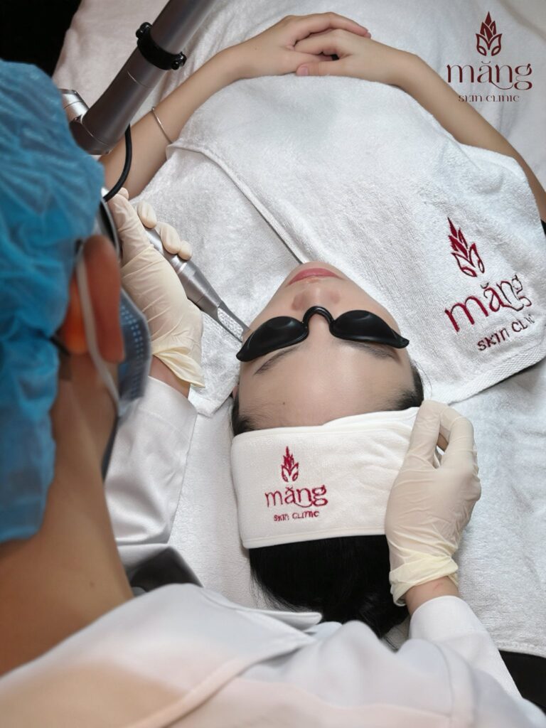 Giải pháp Meso Therapy điều trị nám da hiệu quả