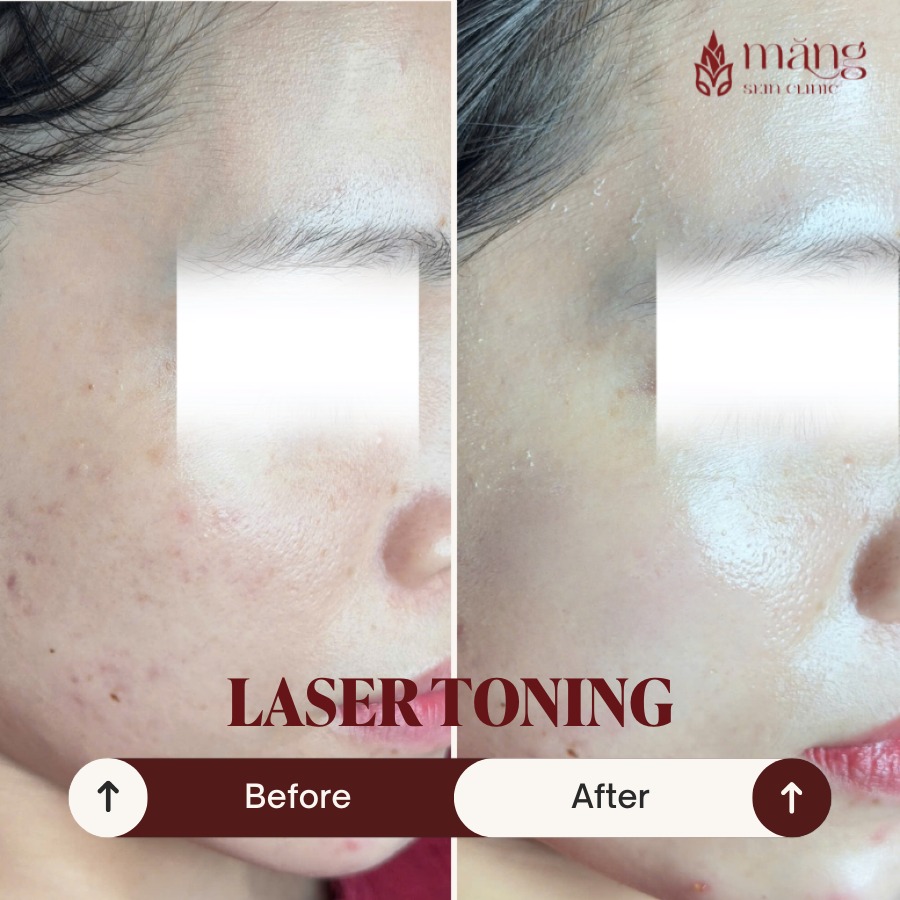 Laser Toning, bí quyết da căng bóng trẻ hóa chỉ sau một liệu trình!
