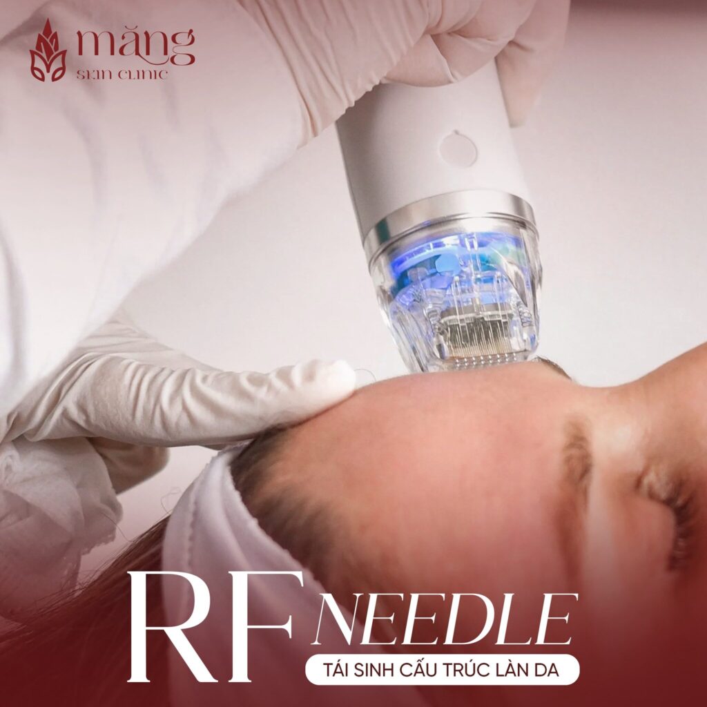 RF Needle và bí mật tái sinh làn da căng bóng, trẻ trung của mình!