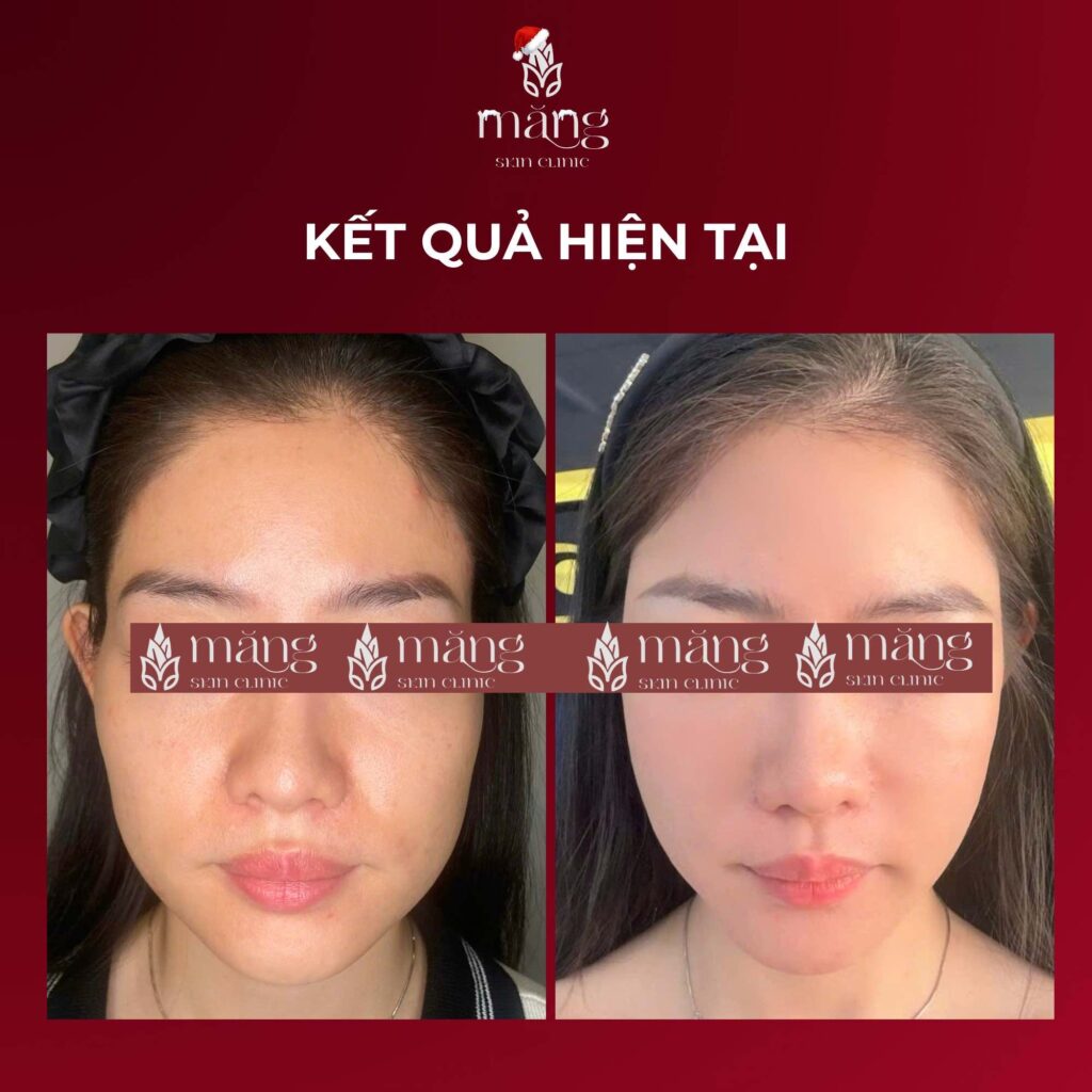 Ai nên làm CFU nâng cơ? Giải mã công nghệ trẻ hoá đang gây sốt