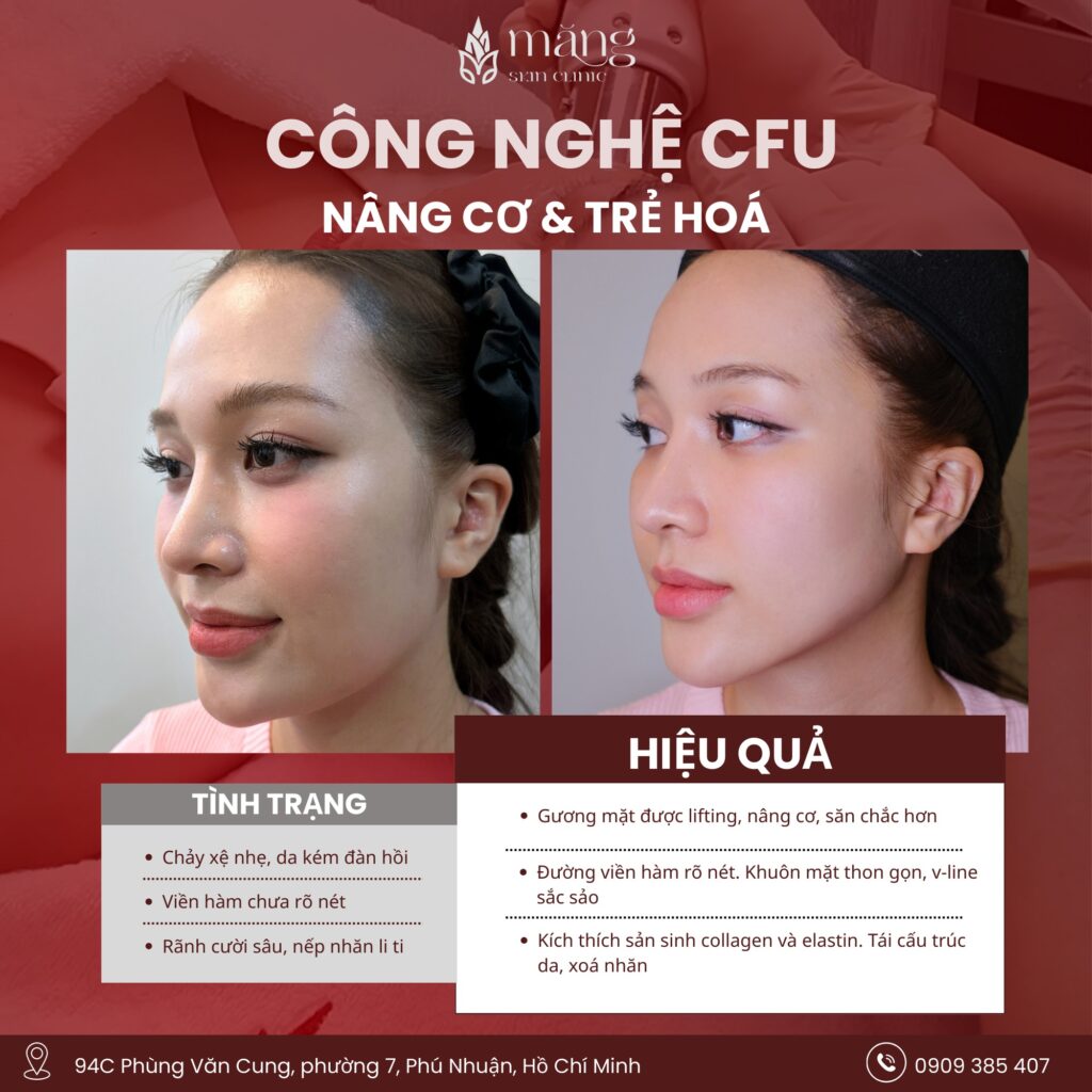 CFU Meso bí kíp xoá nọng cằm rãnh cười "nhẹ nhàng" mà hiệu quả