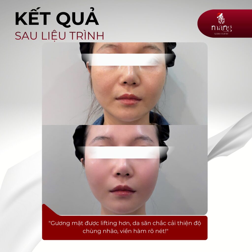 CFU và Ultherapy là gì? khác nhau như thế nào?
