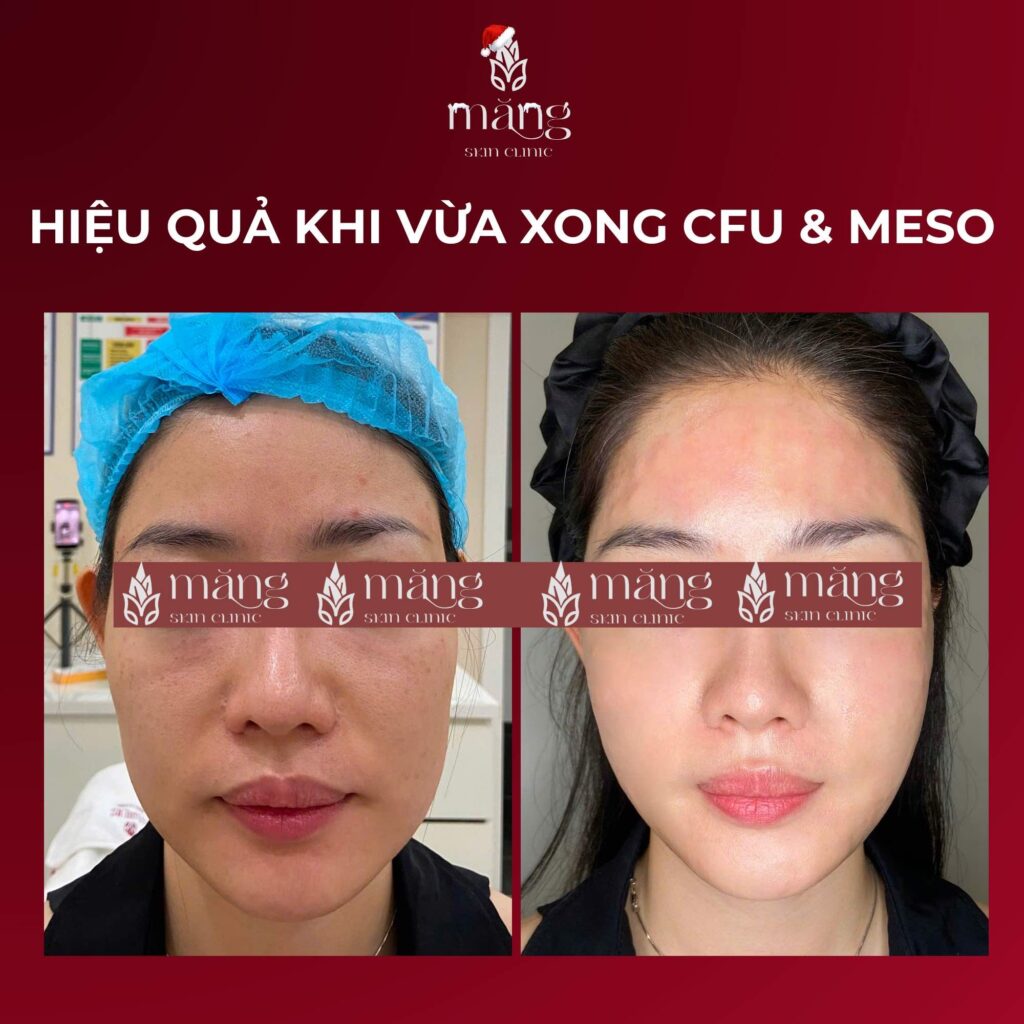 Meso căng bóng Xcelens giải pháp vàng cho làn da lão hoá