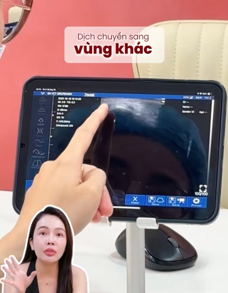 Công nghệ siêu âm Filler chuẩn khoa học là như thế nào?