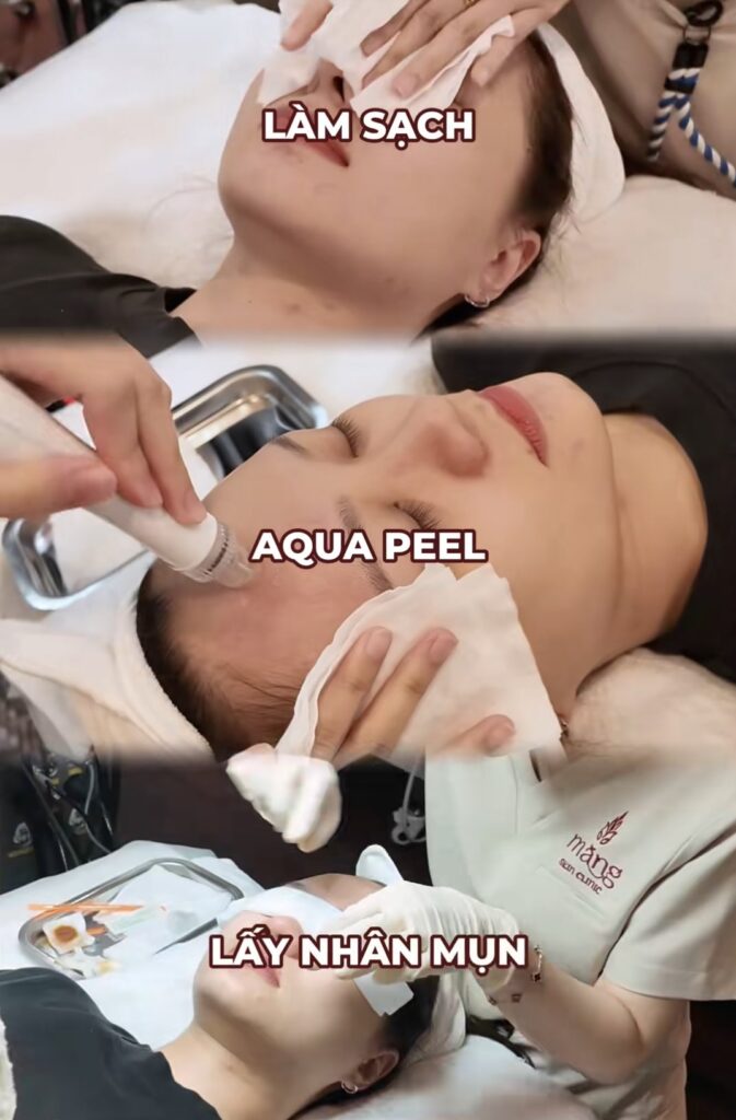 Trẻ hoá da bằng RF tại Măng Skin Clinic có gì hot?