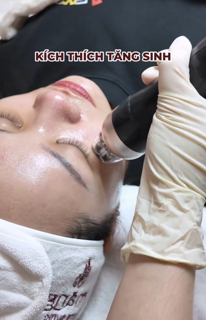 Trẻ hoá bề mặt với công nghệ RF tại Măng Skin Clinic có gì hot?