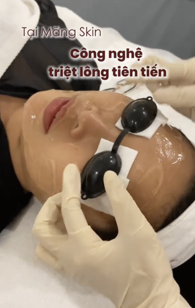 Đánh bay vi-ô-lông với triệt lông công nghệ cao tại Măng Skin Clinic