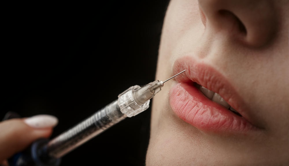 Làm đẹp khoa học: Tiêm filler môi bao lâu thì vào form?