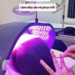 Có nên làm Laser Toning hàng tháng không các nàng?